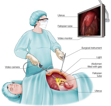 laparoscopic fulguration of endometriosis cpt
